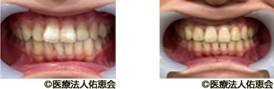 マウスピース治療後の歯の移動の様子 口腔内を撮影