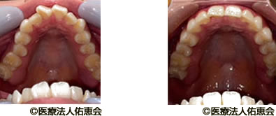 治療例1 マウスピース治療後の歯の移動の様子 口腔内を撮影