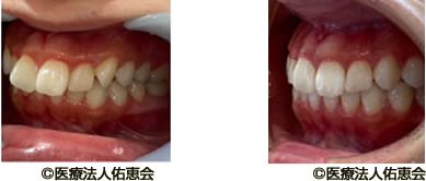 マウスピース治療後の歯の移動の様子 前歯部分