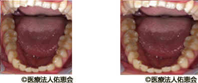 マウスピース治療後の歯の移動の様子 前歯部分