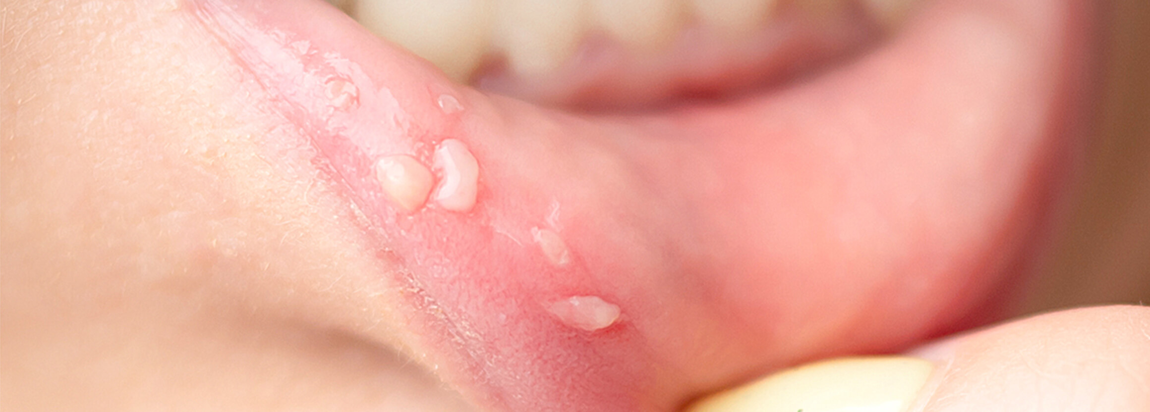 粘液嚢胞、脱臼歯、お子さまのケガにも対応可能